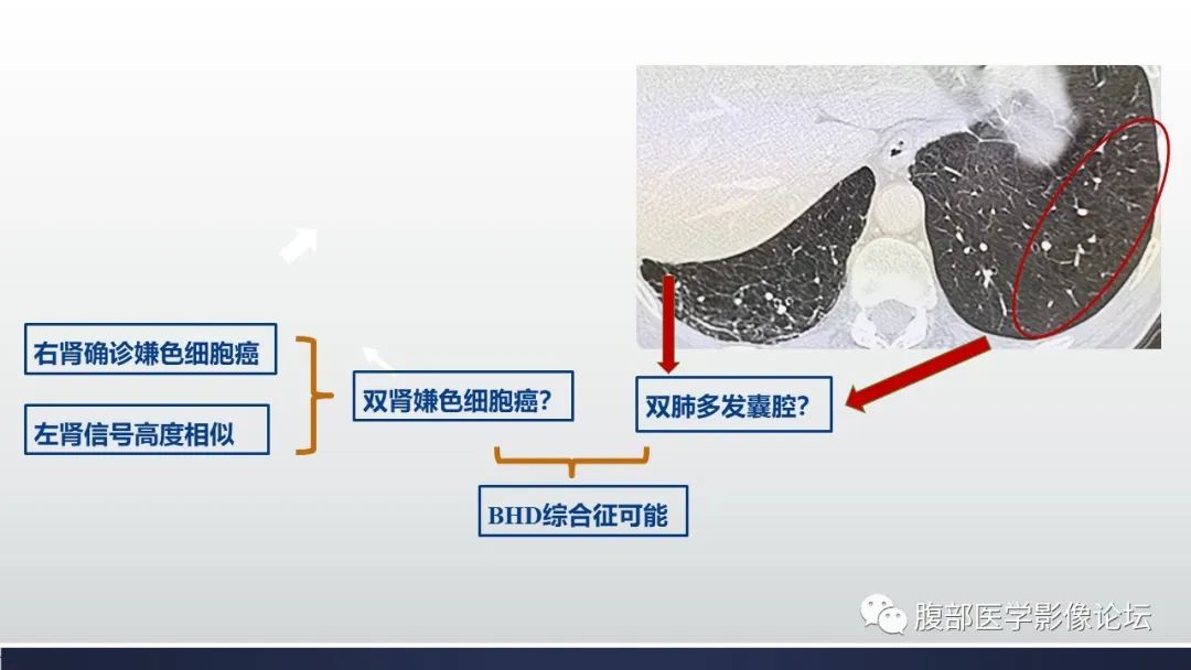 影像PPT - 【病例】肾嫌色细胞癌1例MR影像-29