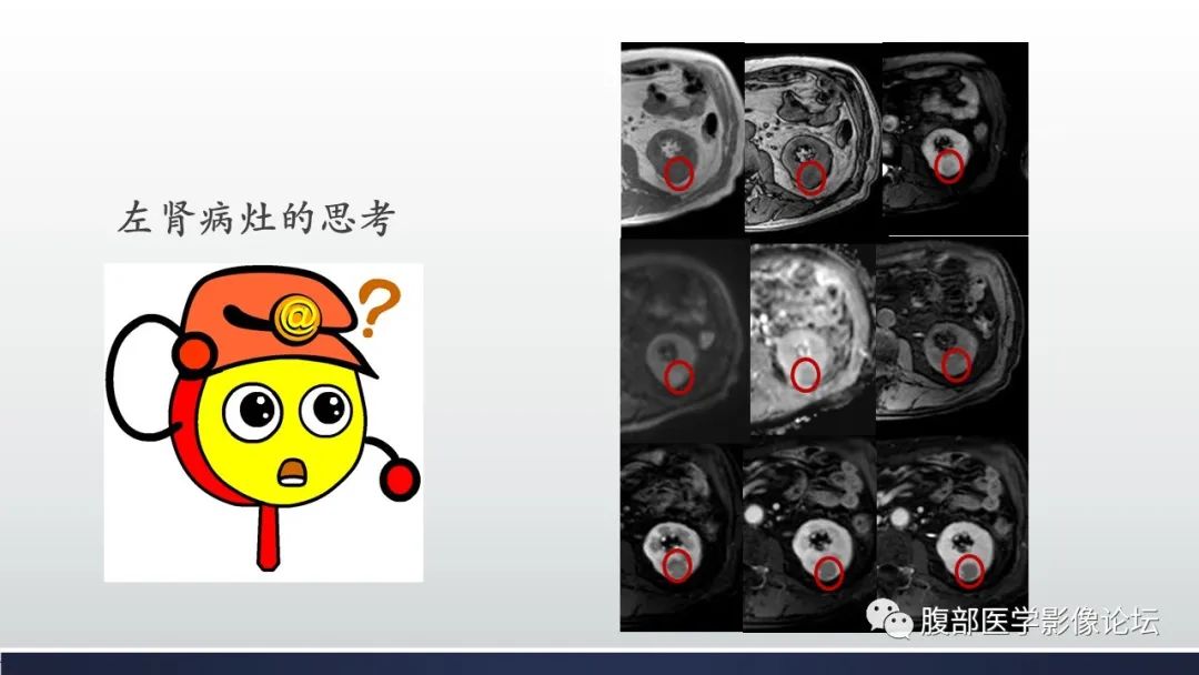 影像PPT - 【病例】肾嫌色细胞癌1例MR影像-28