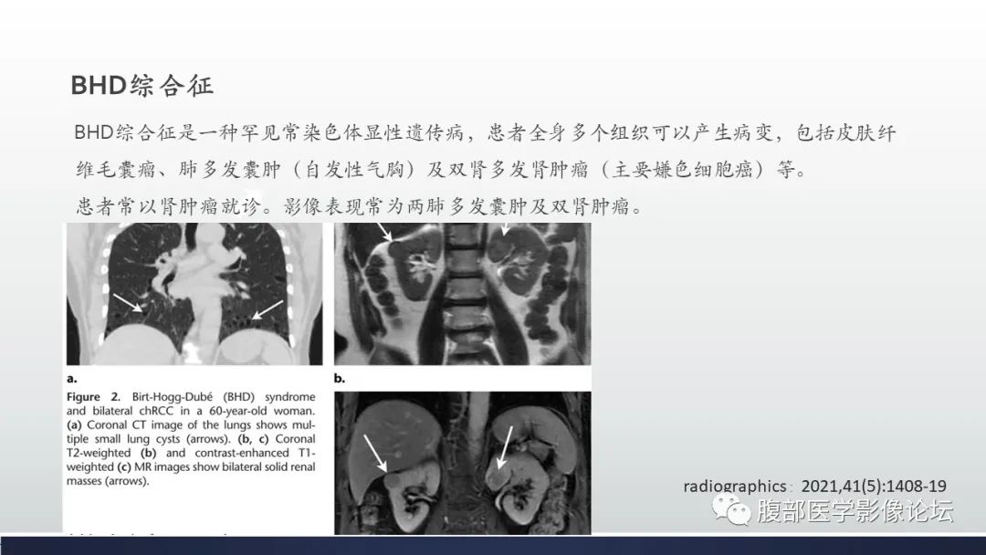 影像PPT - 【病例】肾嫌色细胞癌1例MR影像-30