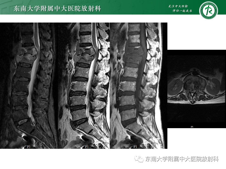 影像PPT - 【PPT】脊柱终板周围病变-7