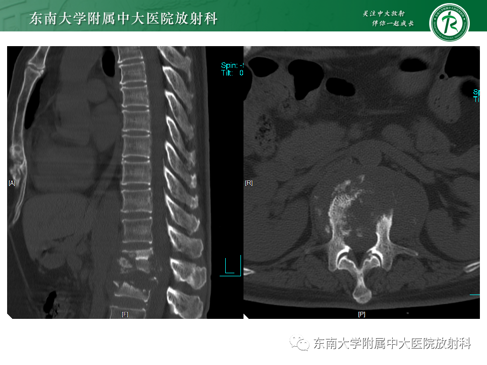 影像PPT - 【PPT】脊柱终板周围病变-8