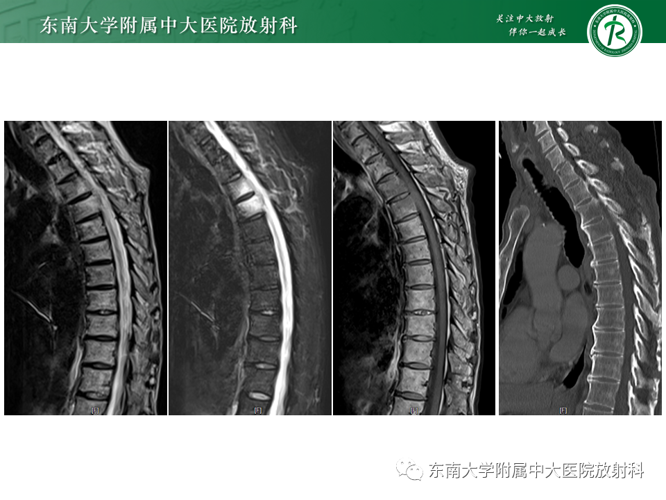 影像PPT - 【PPT】脊柱终板周围病变-11