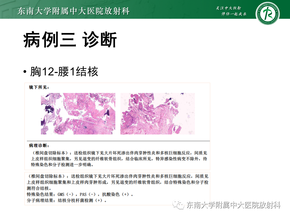 影像PPT - 【PPT】脊柱终板周围病变-9