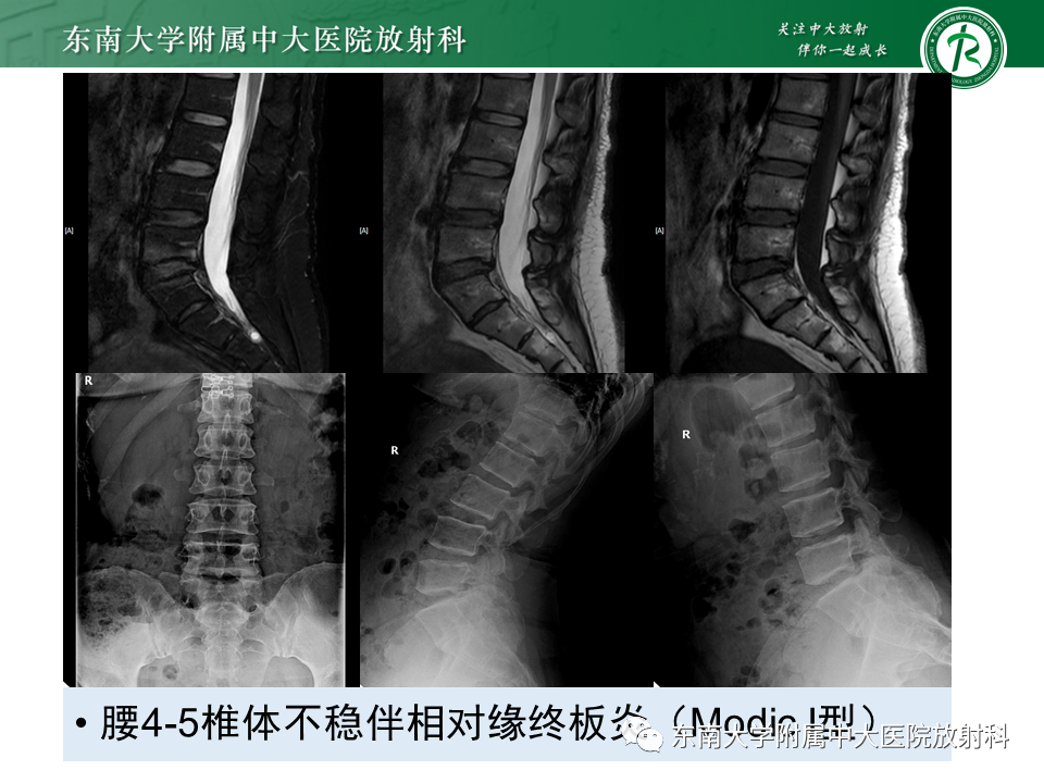 影像PPT - 【PPT】脊柱终板周围病变-2