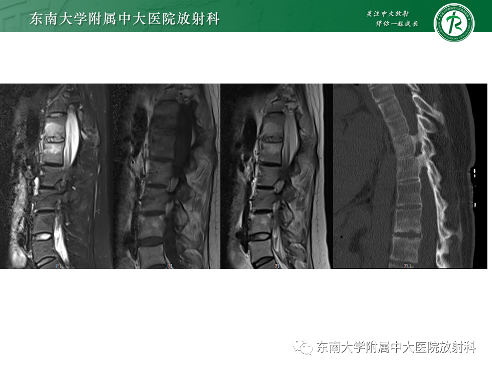 影像PPT - 【PPT】脊柱终板周围病变-4