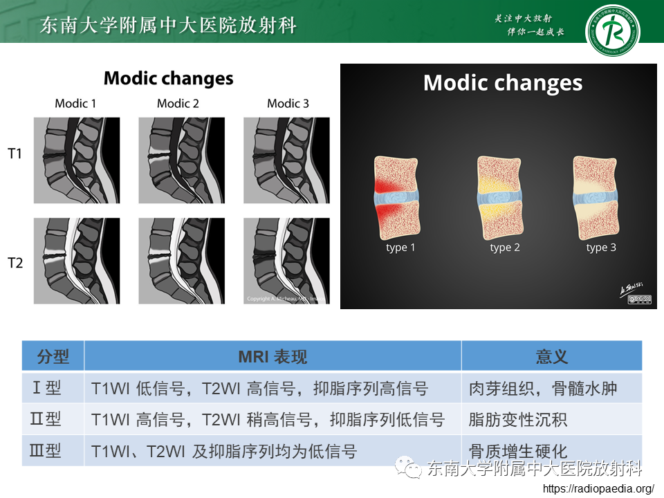 影像PPT - 【PPT】脊柱终板周围病变-19