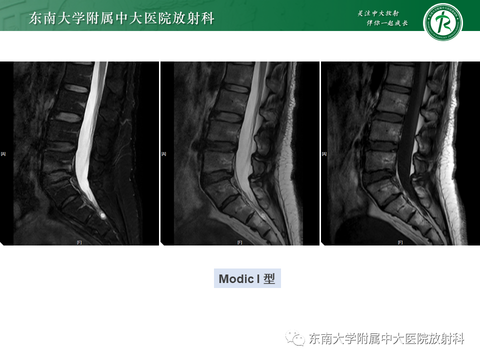 影像PPT - 【PPT】脊柱终板周围病变-21