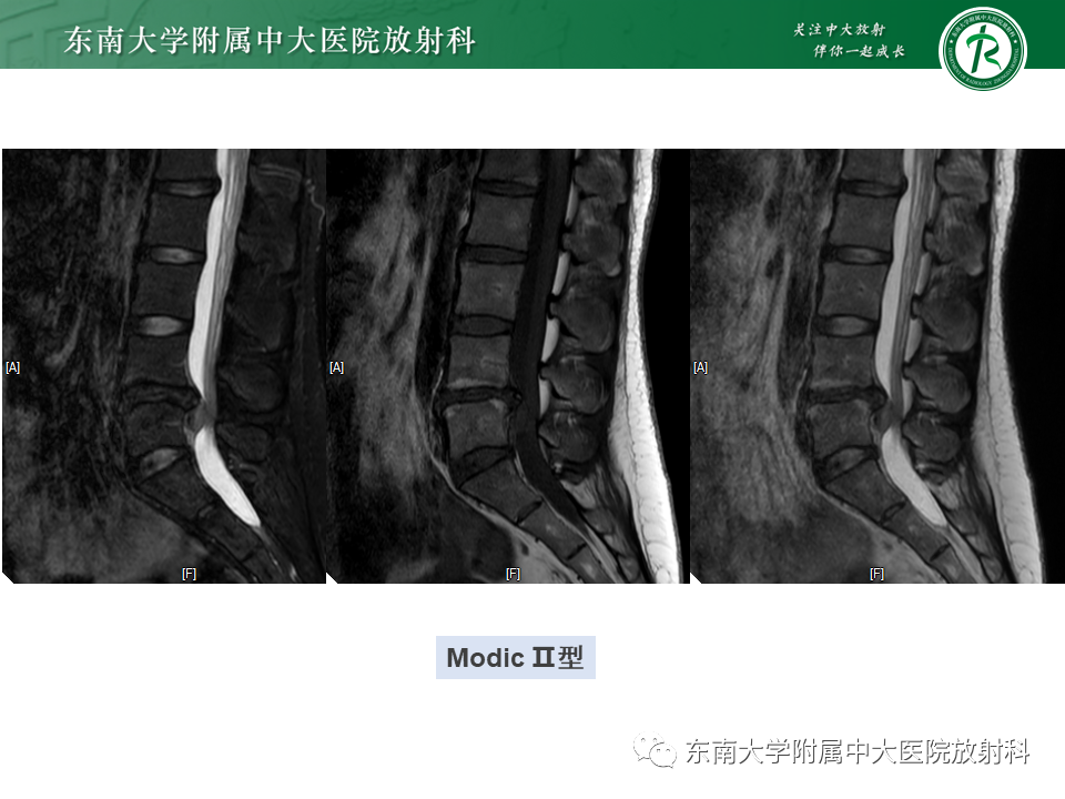 影像PPT - 【PPT】脊柱终板周围病变-22