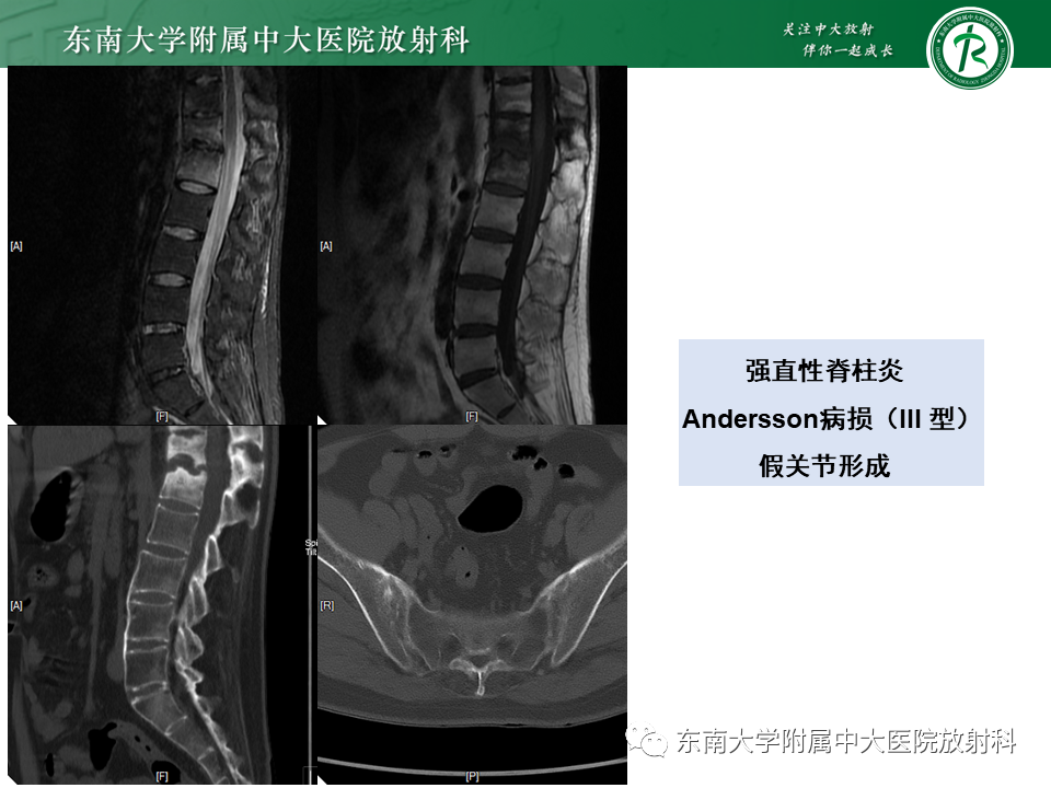影像PPT - 【PPT】脊柱终板周围病变-30