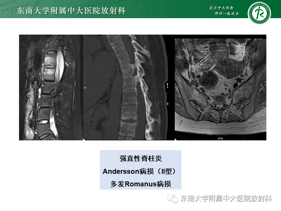 影像PPT - 【PPT】脊柱终板周围病变-29