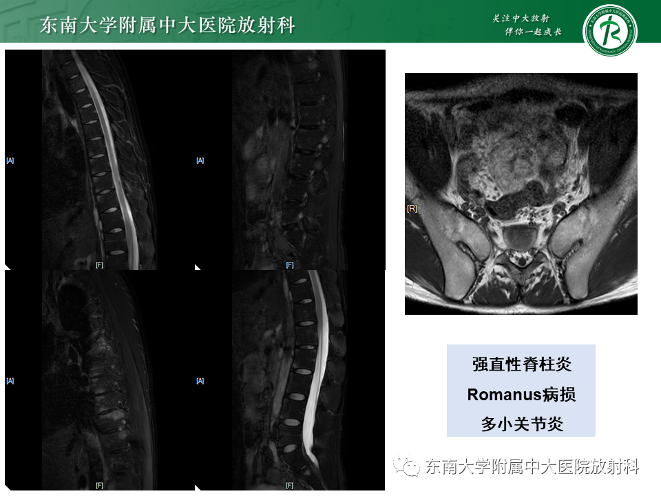 影像PPT - 【PPT】脊柱终板周围病变-28