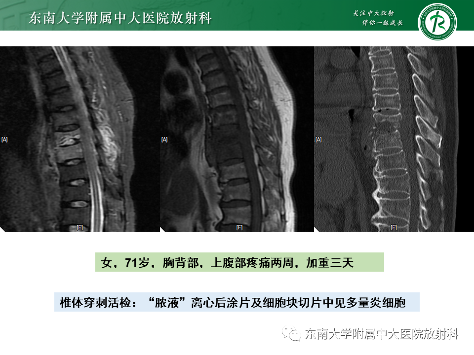 影像PPT - 【PPT】脊柱终板周围病变-35