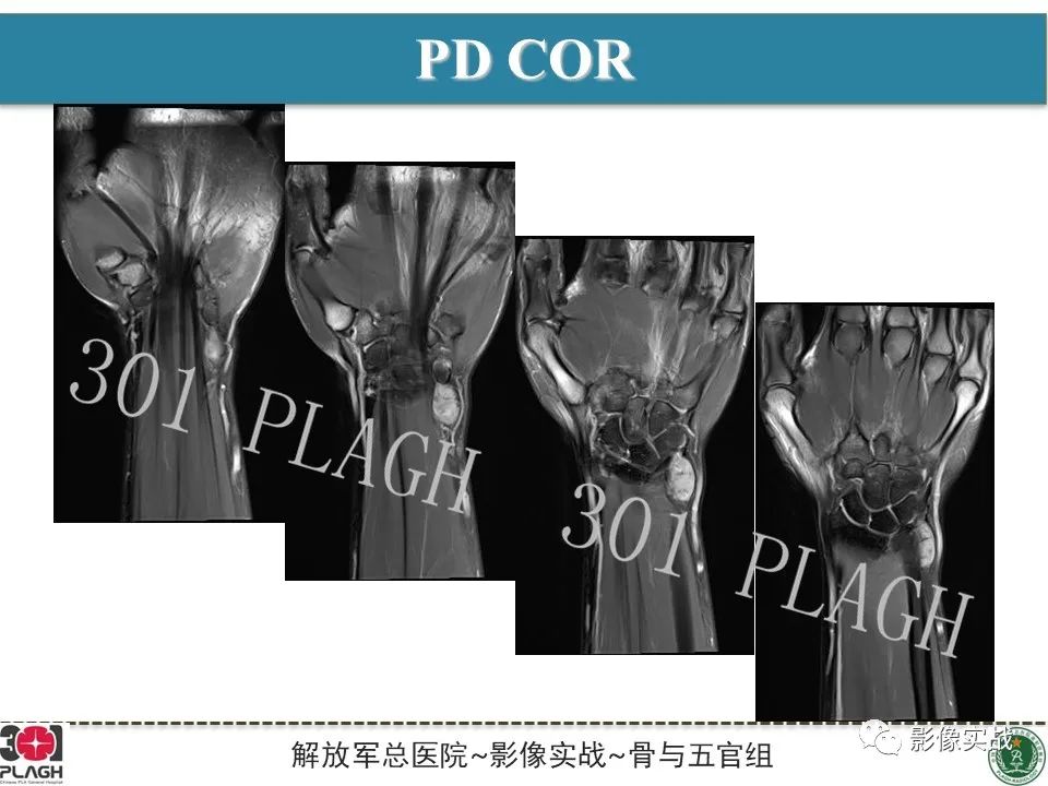 影像PPT - 【PPT】腕部腱鞘巨细胞瘤1例MR影像-5