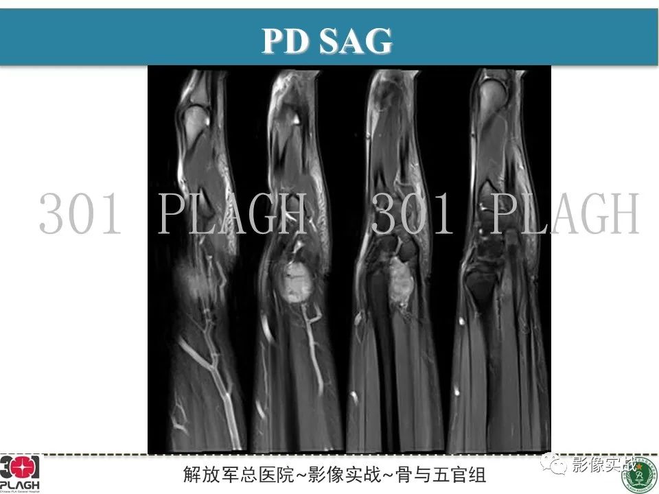 影像PPT - 【PPT】腕部腱鞘巨细胞瘤1例MR影像-3