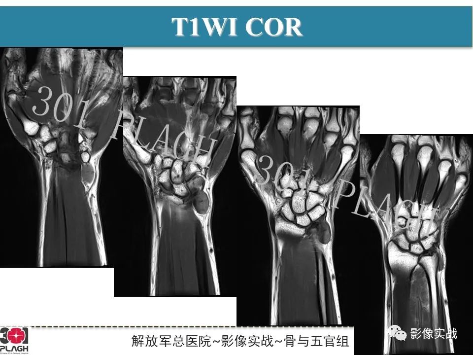 影像PPT - 【PPT】腕部腱鞘巨细胞瘤1例MR影像-4