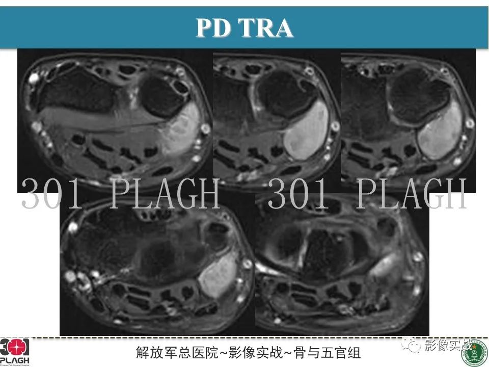 影像PPT - 【PPT】腕部腱鞘巨细胞瘤1例MR影像-7