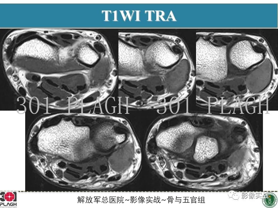 影像PPT - 【PPT】腕部腱鞘巨细胞瘤1例MR影像-6
