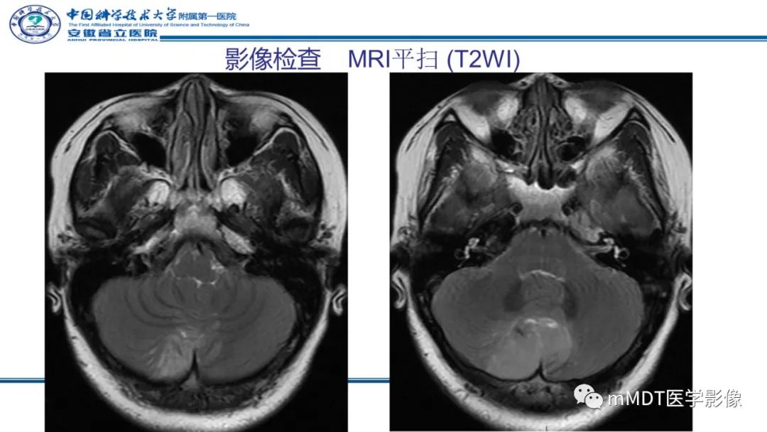 影像PPT - 【PPT】小脑髓母细胞瘤病例解析-5