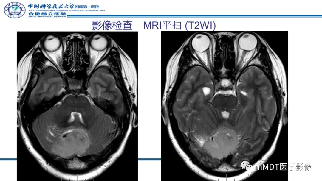 影像PPT - 【PPT】小脑髓母细胞瘤病例解析-6
