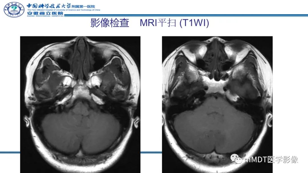 影像PPT - 【PPT】小脑髓母细胞瘤病例解析-9