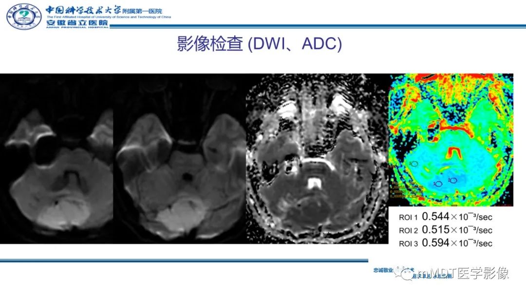 影像PPT - 【PPT】小脑髓母细胞瘤病例解析-11