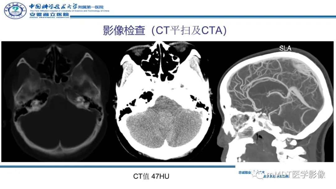 影像PPT - 【PPT】小脑髓母细胞瘤病例解析-4