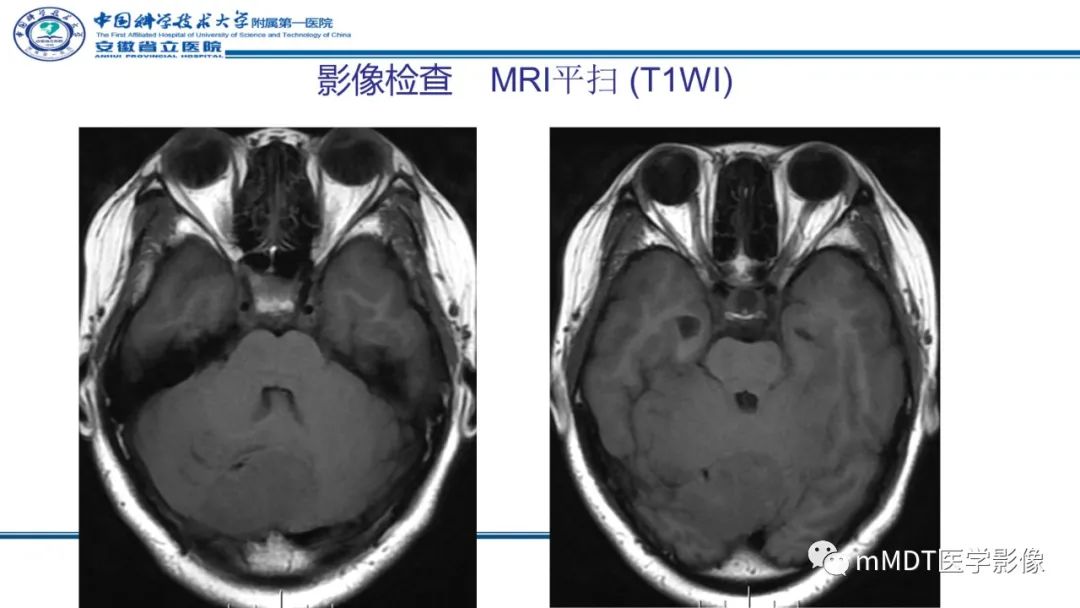 影像PPT - 【PPT】小脑髓母细胞瘤病例解析-10