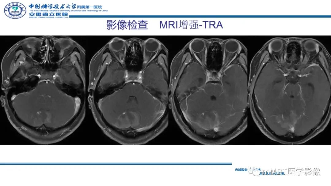 影像PPT - 【PPT】小脑髓母细胞瘤病例解析-12