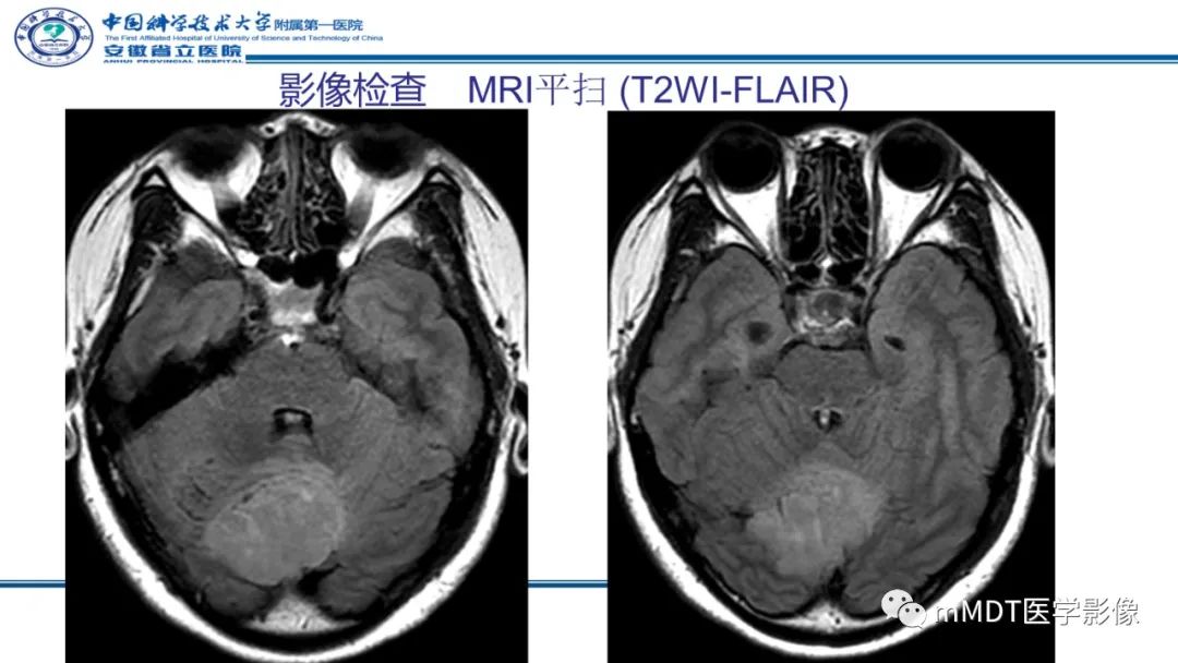 影像PPT - 【PPT】小脑髓母细胞瘤病例解析-8