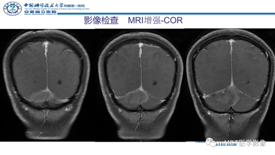 影像PPT - 【PPT】小脑髓母细胞瘤病例解析-14