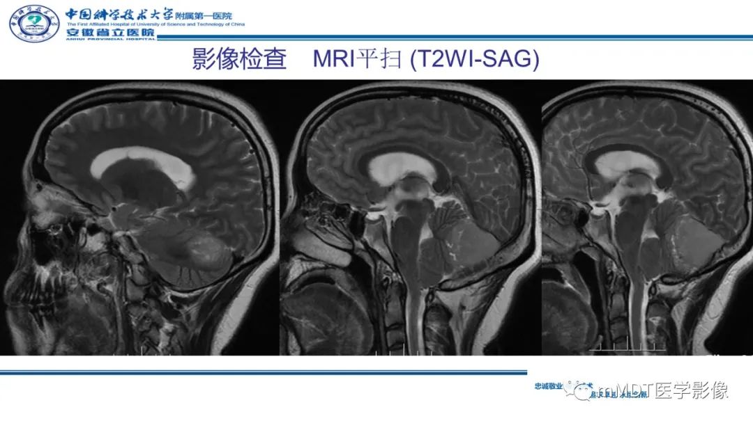 影像PPT - 【PPT】小脑髓母细胞瘤病例解析-7