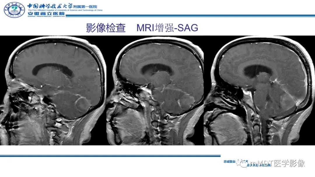 影像PPT - 【PPT】小脑髓母细胞瘤病例解析-13