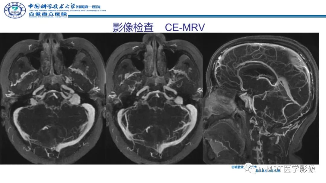 影像PPT - 【PPT】小脑髓母细胞瘤病例解析-15