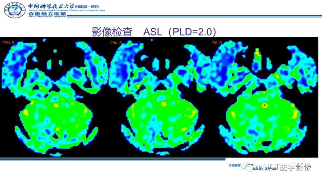 影像PPT - 【PPT】小脑髓母细胞瘤病例解析-16