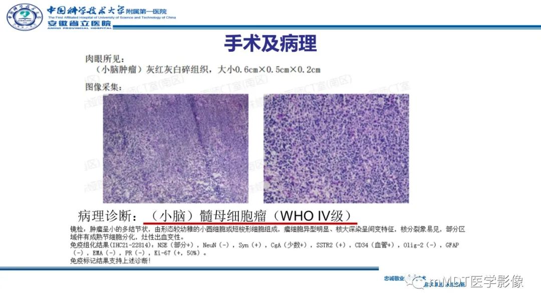 影像PPT - 【PPT】小脑髓母细胞瘤病例解析-25