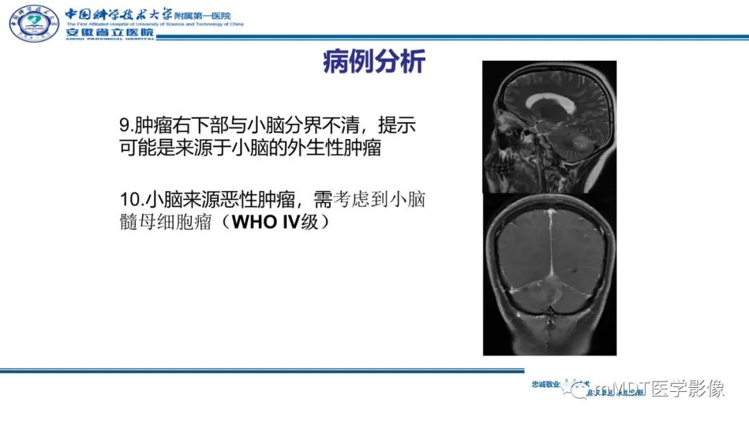 影像PPT - 【PPT】小脑髓母细胞瘤病例解析-23