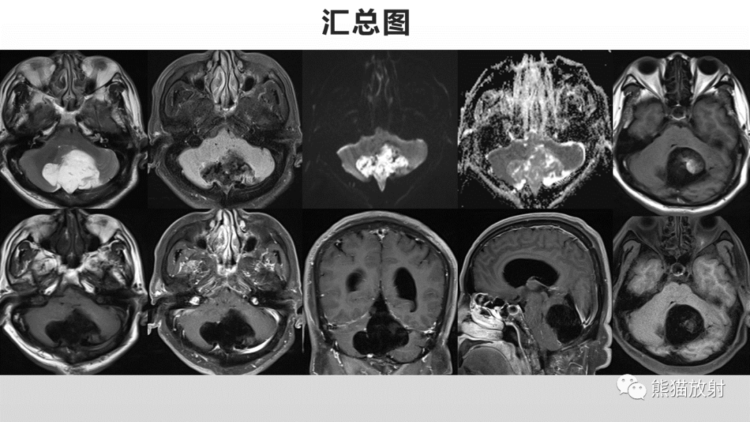 影像PPT - 【病例】颅内畸胎瘤 VS 表皮样囊肿-11