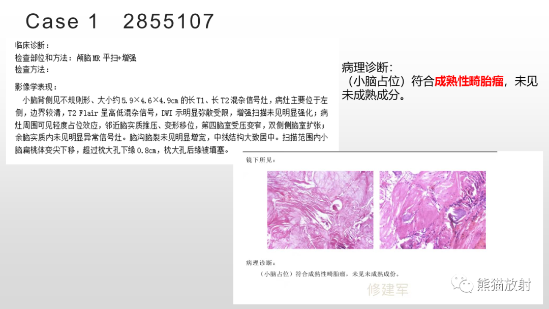 影像PPT - 【病例】颅内畸胎瘤 VS 表皮样囊肿-24