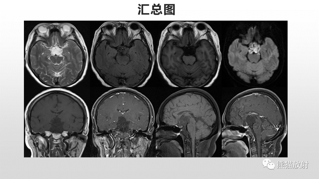 影像PPT - 【病例】颅内畸胎瘤 VS 表皮样囊肿-22