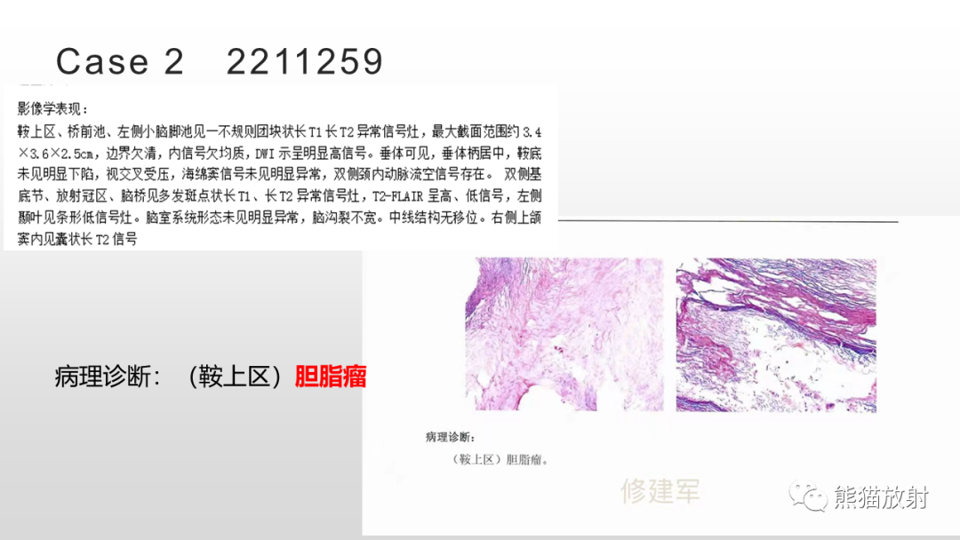 影像PPT - 【病例】颅内畸胎瘤 VS 表皮样囊肿-25