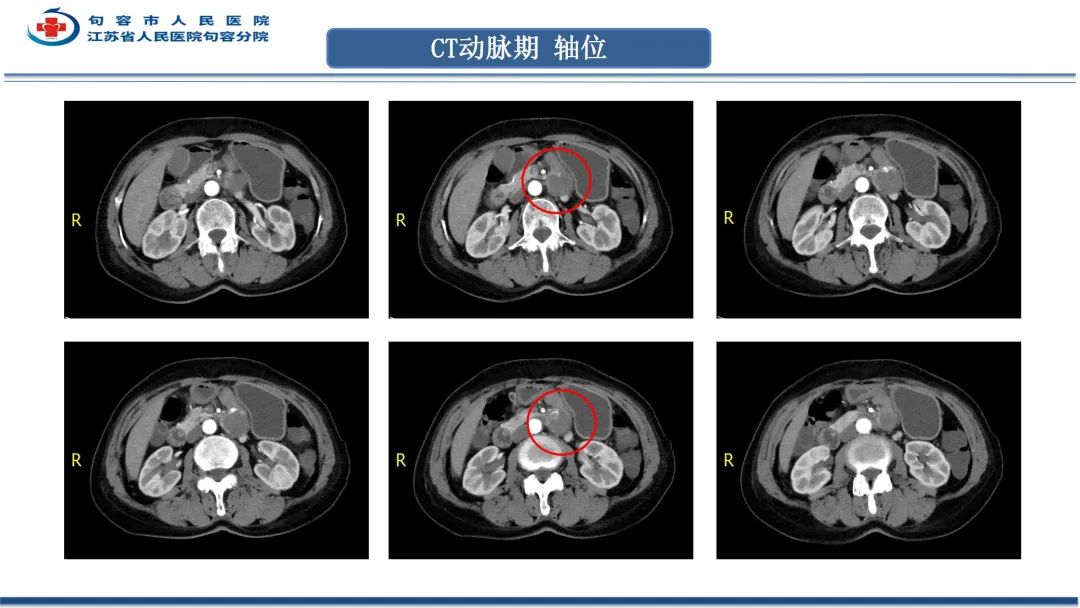 影像PPT - 【PPT】十二指肠血管瘤-8