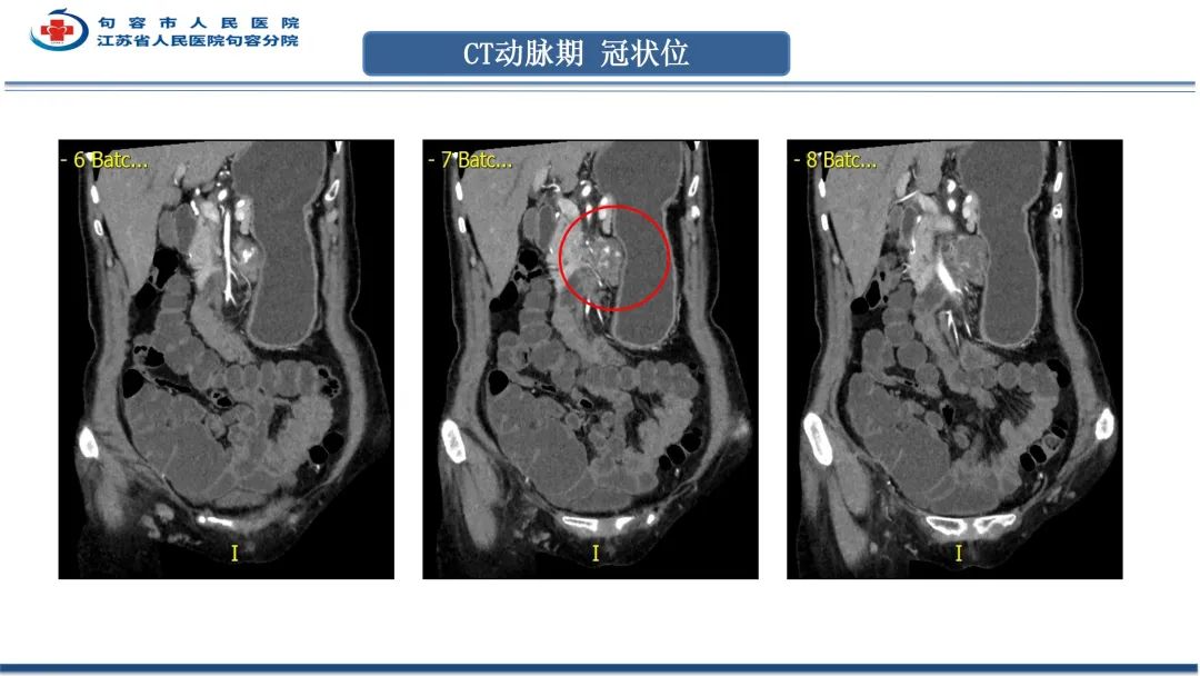 影像PPT - 【PPT】十二指肠血管瘤-10