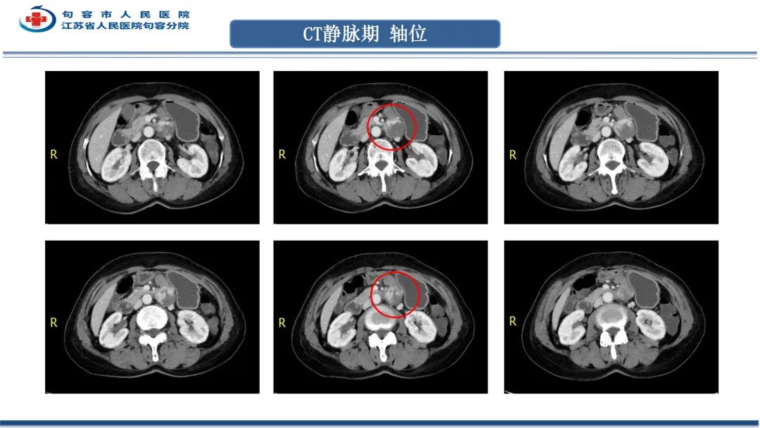 影像PPT - 【PPT】十二指肠血管瘤-9