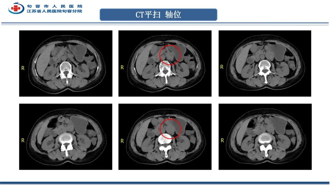 影像PPT - 【PPT】十二指肠血管瘤-7