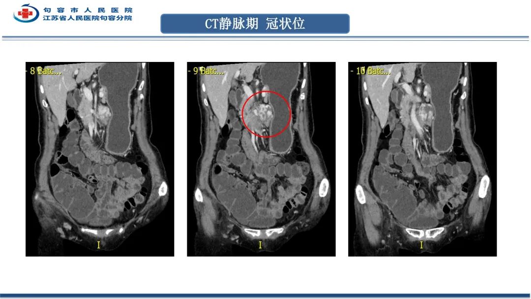影像PPT - 【PPT】十二指肠血管瘤-11