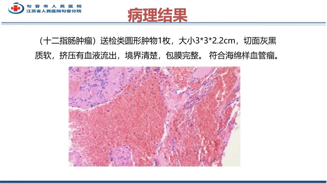 影像PPT - 【PPT】十二指肠血管瘤-16
