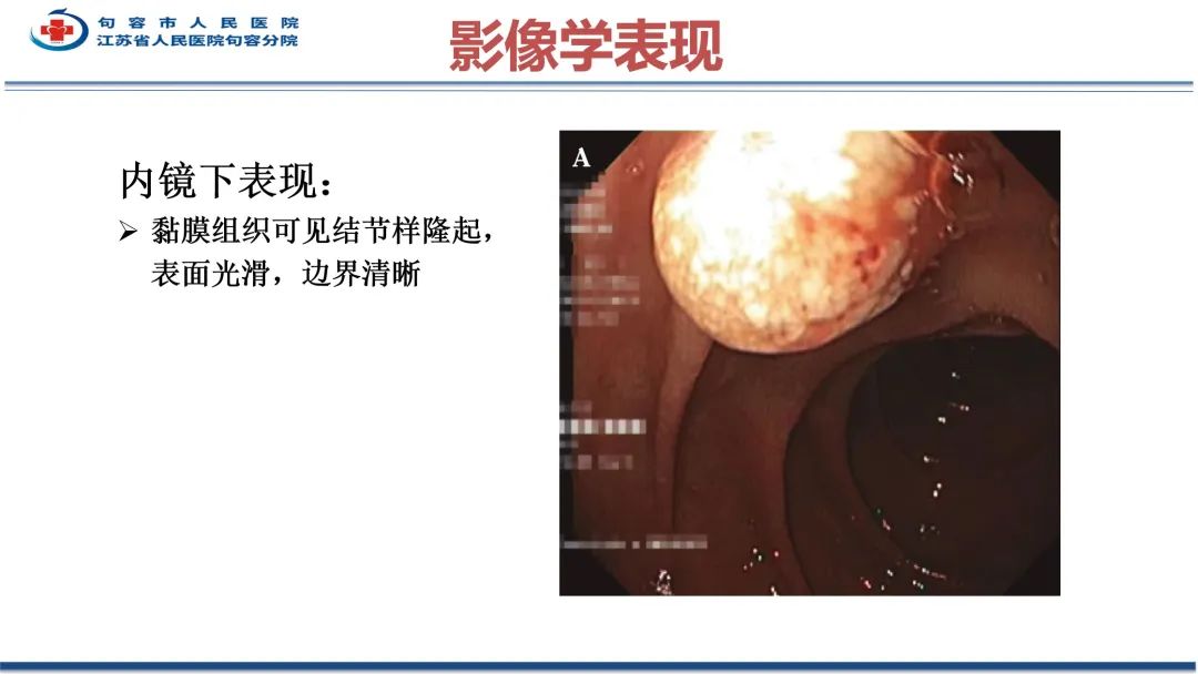 影像PPT - 【PPT】十二指肠血管瘤-26