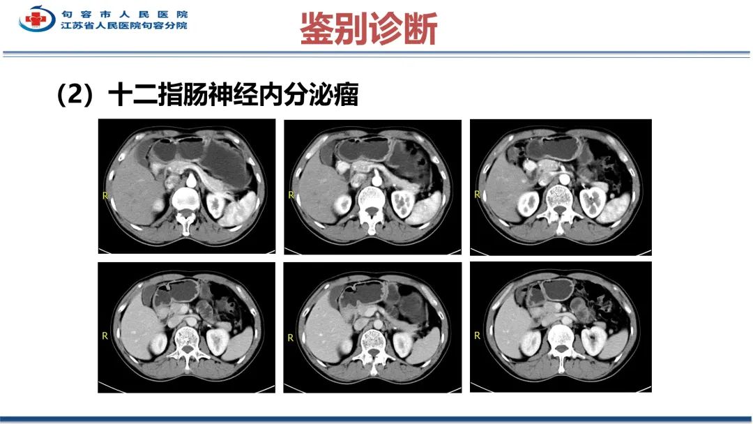 影像PPT - 【PPT】十二指肠血管瘤-32
