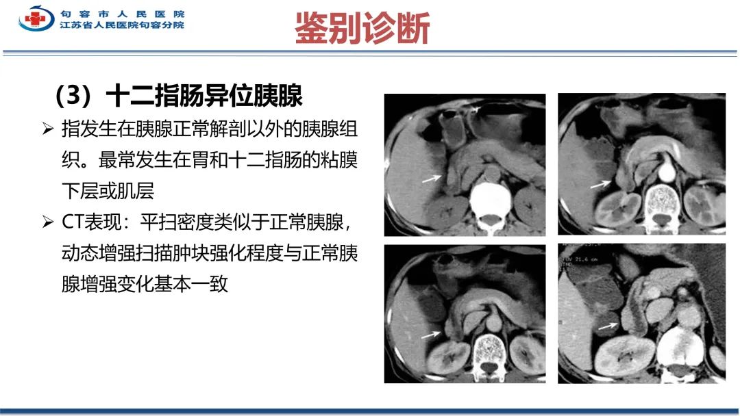 影像PPT - 【PPT】十二指肠血管瘤-33