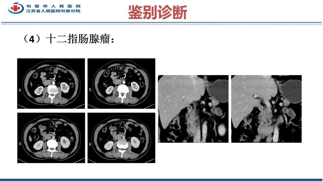 影像PPT - 【PPT】十二指肠血管瘤-35